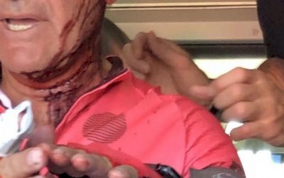 Ex-piloto da Moto GP leva tiros na cabeça e sobrevive; atleta mostra a cicatriz em rede social