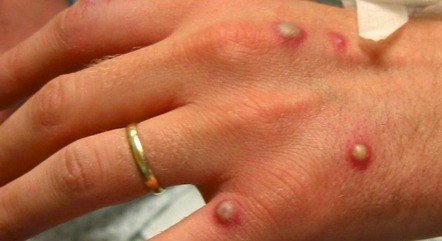 Holanda detecta mais casos de varíola dos macacos, dizem autoridades de saúde