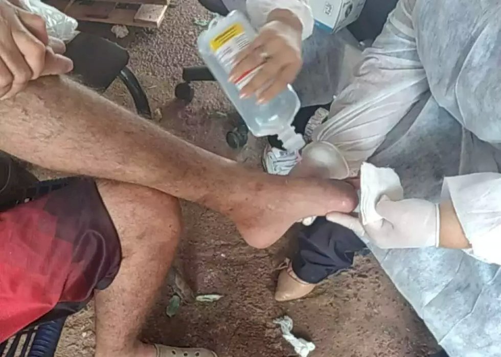 Cansado de esperar em fila de cirurgia, homem amputa dedos sozinho