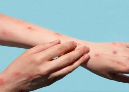 SESAU investiga caso de MPOX em Campo Grande