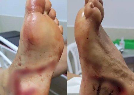 Turista tem corte profundo no pé após levar mordida de dourado no Rio Formoso